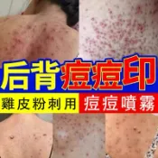 【背粒消噴霧】日本爆款 痘痘噴霧 背部痘痘 胸前痘 毛孔堵塞 雞皮 皮膚瘙癢 全身痘可用 溫和型 皮膚護理 買四送一