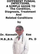Kobo Different Fungal Infections, A Simple Guide To The Condition, Diagnosis, Treatment And Relat