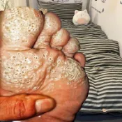 嵌套角質病蜂窩沙蟲體上最多角質脫模鞋底蜂窩沙蟲腳癢帶水泡水泡腳臭架腳白7.28 CWC