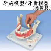益智城《人體模型/牙模型/教學模型》牙病模型/牙齒模型(16顆牙齒可拆下,2倍大,蛀齒,齒菌斑,牙結石,牙周病)德國製