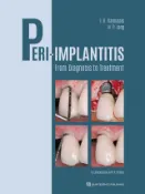 Kobo Peri-Implantitis
