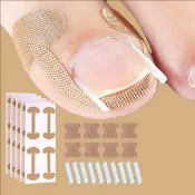 【台灣發貨】甲溝正甲貼 腳趾甲矯正 修甲溝炎正甲貼片 甲溝炎 卷甲矯正器 指甲紮肉 矯正貼片 趾甲糾正 腳趾甲